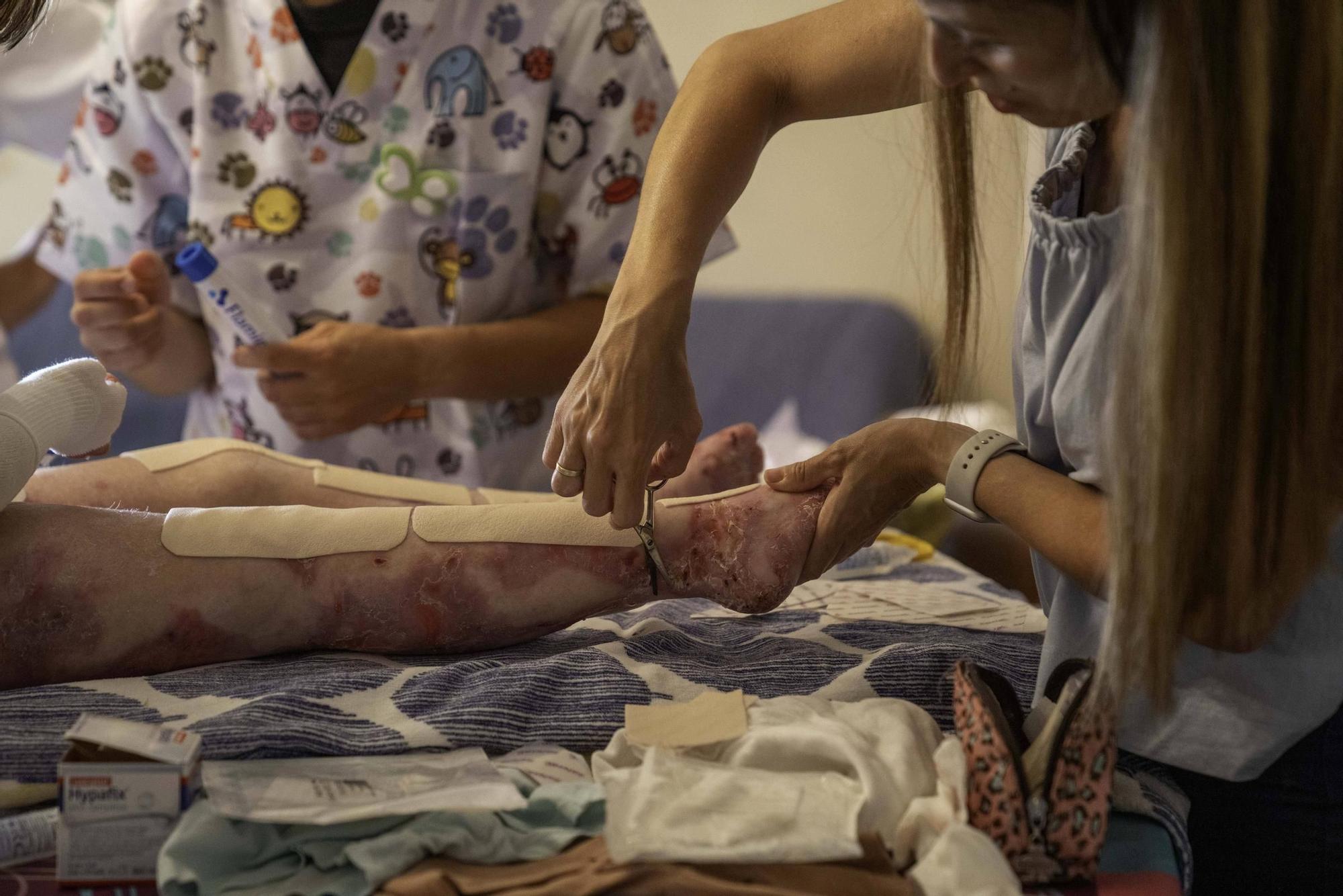 Vivir con piel de mariposa: "El dolor es insoportable"