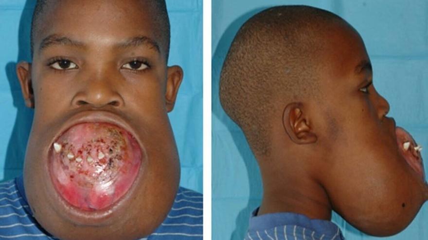 Ameloblastoma: el tumor que rara vez mata pero te destroza la boca y se cura desde la pierna
