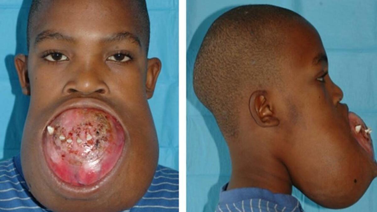 Un paciente con ameloblastoma