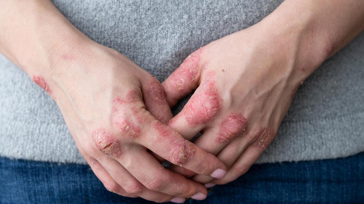 La psoriasis es una enfermedad inflamatoria crónica que se caracteriza por la aparición de placas rojas y escamosas en la piel