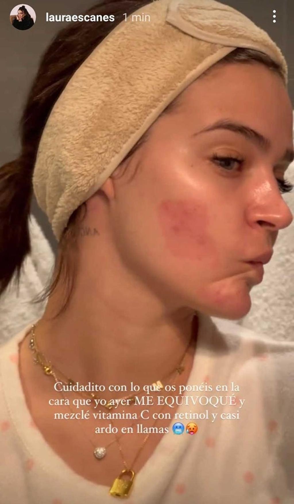Laura Escanes con la cara abrasada