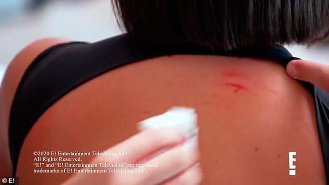 La pelea de Kourtney y Kim se saldó con esta herida en la espalda de Kim