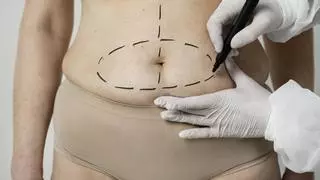 ¿Es lo mismo una liposucción que una lipoescultura? ¿Cuál me aconseja para mejorar mi aspecto?