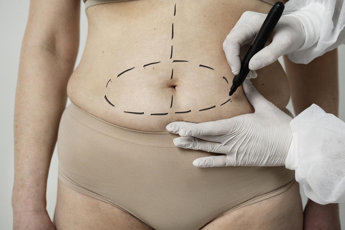 ¿Es lo mismo una liposucción que una lipoescultura?