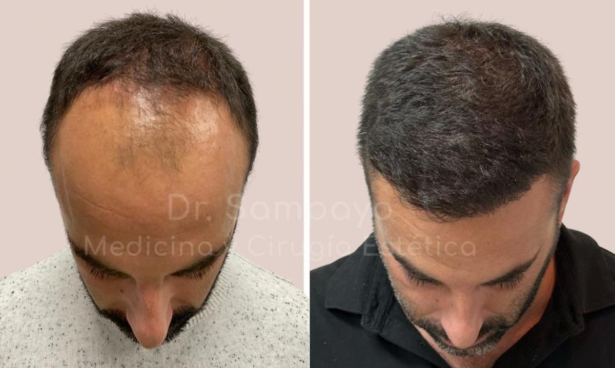 El antes y después de un paciente de la Clínica Doctor Sampayo en Valencia.