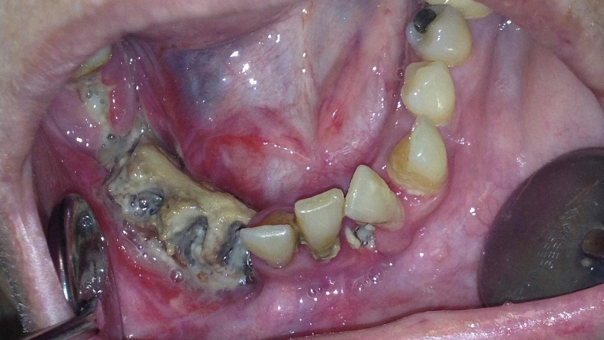 La osteonecrosis maxilar es una patología en la que se produce la necrosis del hueso mandibular.