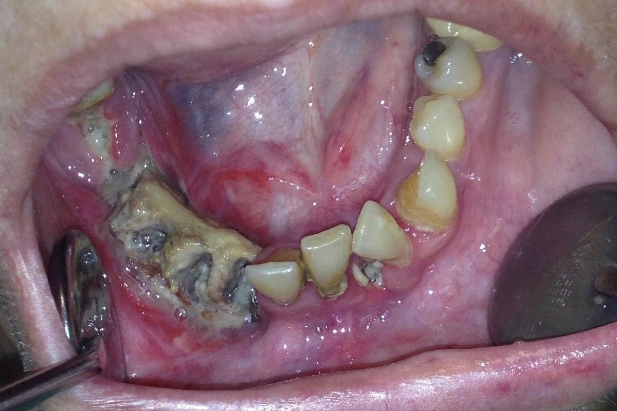 La osteonecrosis maxilar es una patología en la que se produce la necrosis del hueso mandibular.