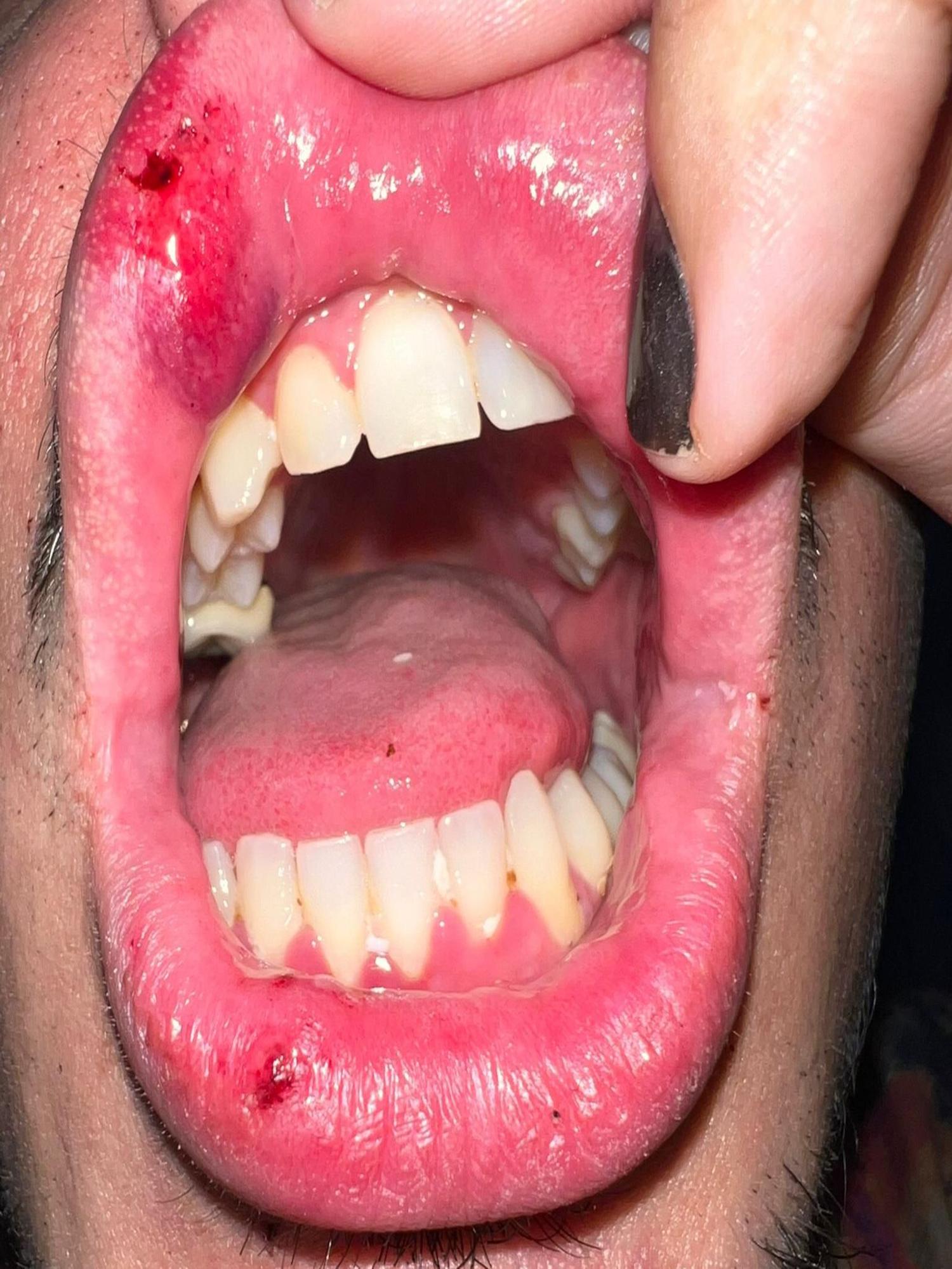 El labio de M.R. tras la agresión, con varias heridas e inflamación.