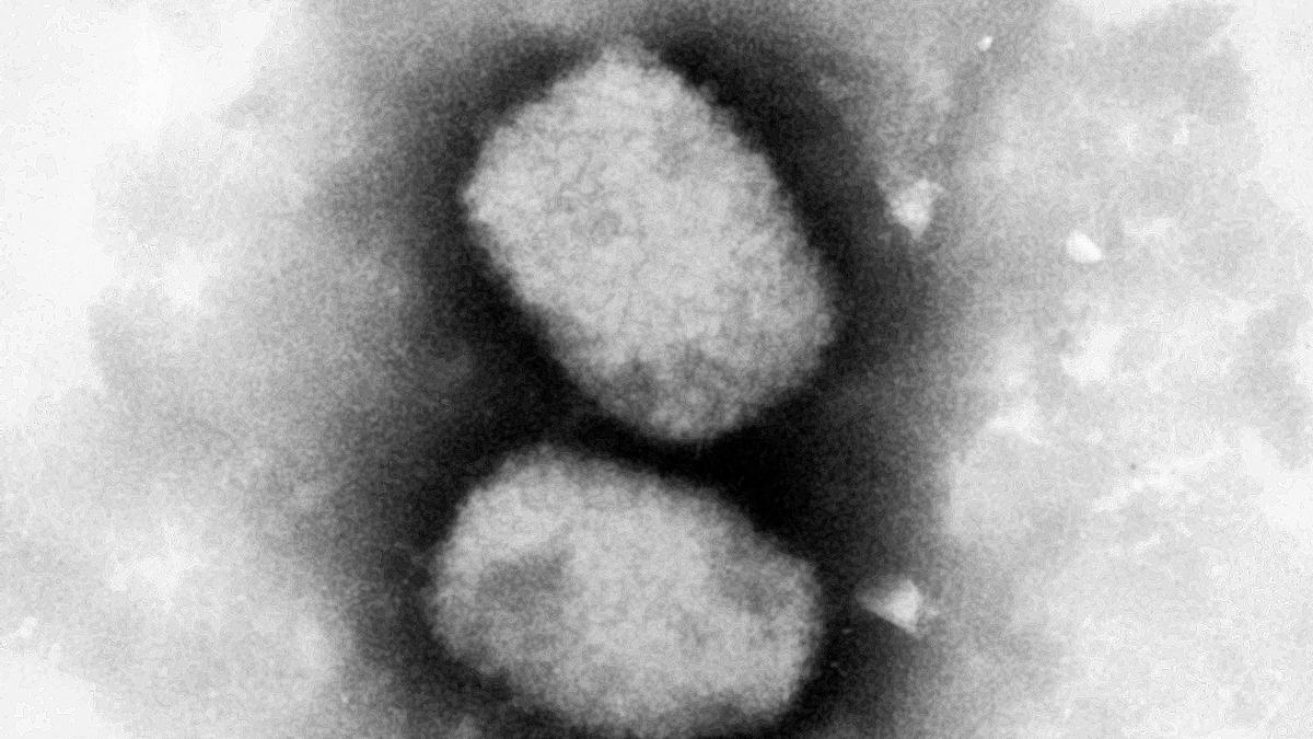 Archivo - El virus de la viruela del mono