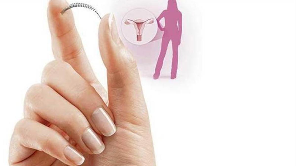 El dispositivo anticonceptivo Essure que centra este caso. // FDV