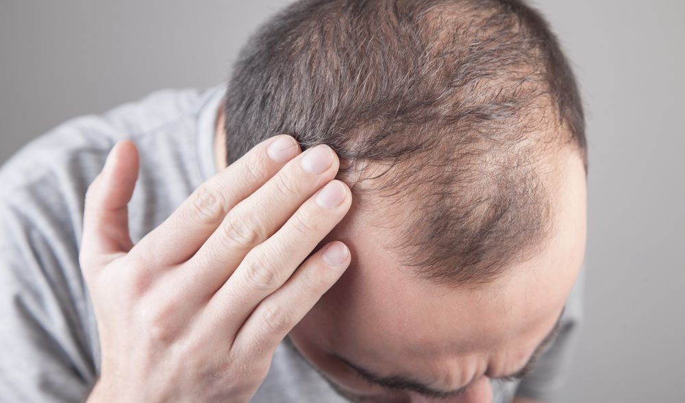 El 90% de los casos de alopecia en España son de tipo androgénico, es decir, se trata de una pérdida de pelo de origen hereditario