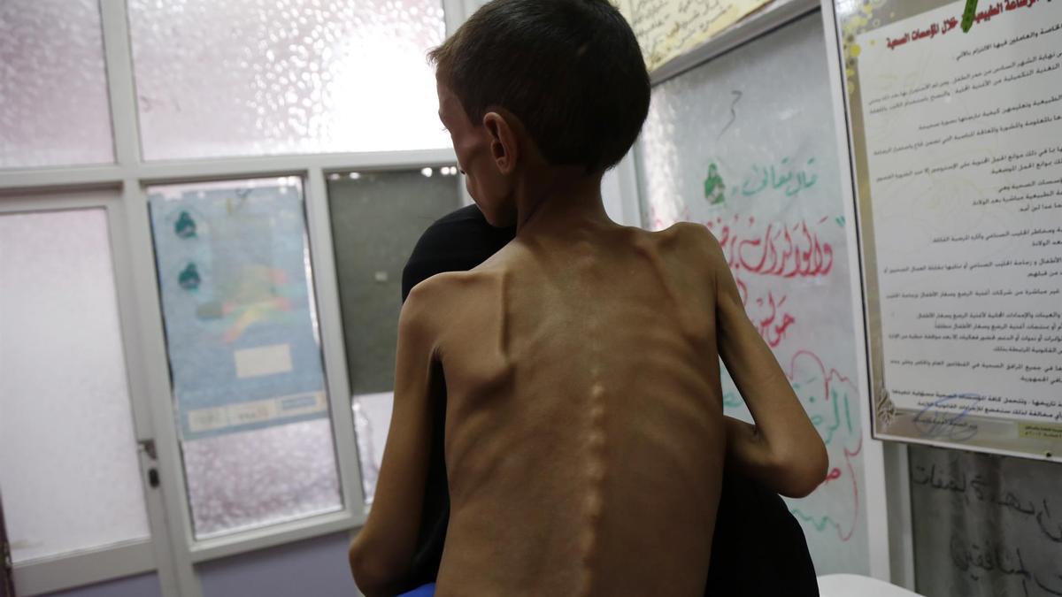 Niño desnutrido en un hospital de Saná, en Yemen.