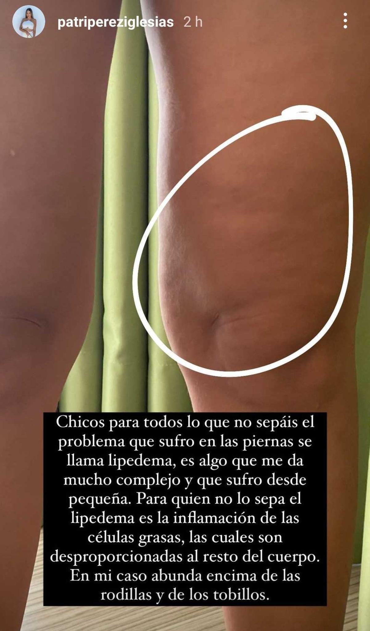 Patri Pérez enseña la enfermedad que sufre