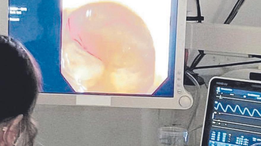 88.000 canarios se saltan                     el cribado de cáncer de colon
