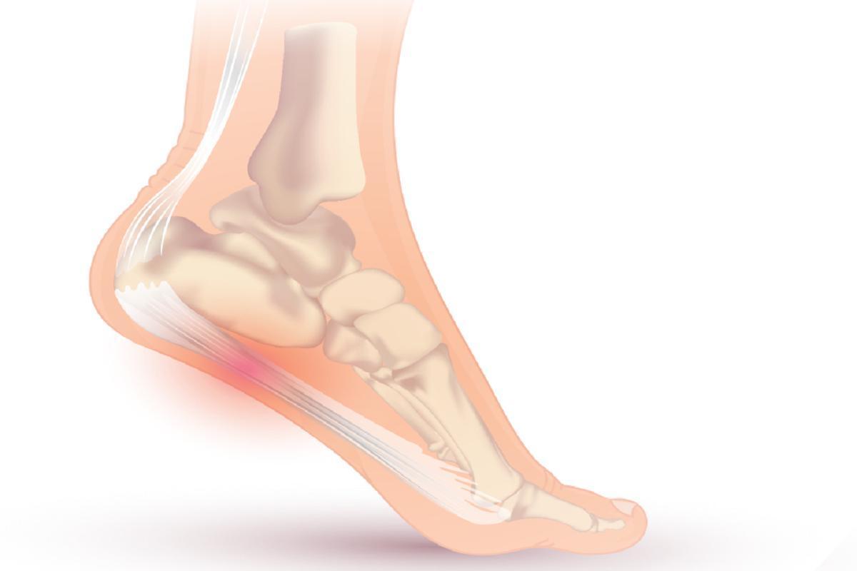 La fascitis plantar es la lesión más frecuente que provoca la transición al calzado de verano.