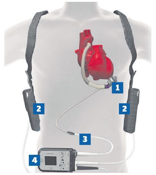 1 La bomba que ayuda a la irrigación sanguínea se coloca en un extremo del ventrículo izquierdo. 2 Las dos baterías que alimentan al ordenador. 3 Cable que conecta la bomba al ordenador.  4 El ordenador que controla una correcta función coronaria.