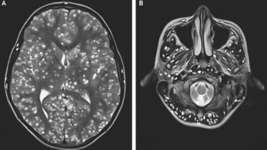 Un joven fallece por una plaga de gusanos en su cerebro