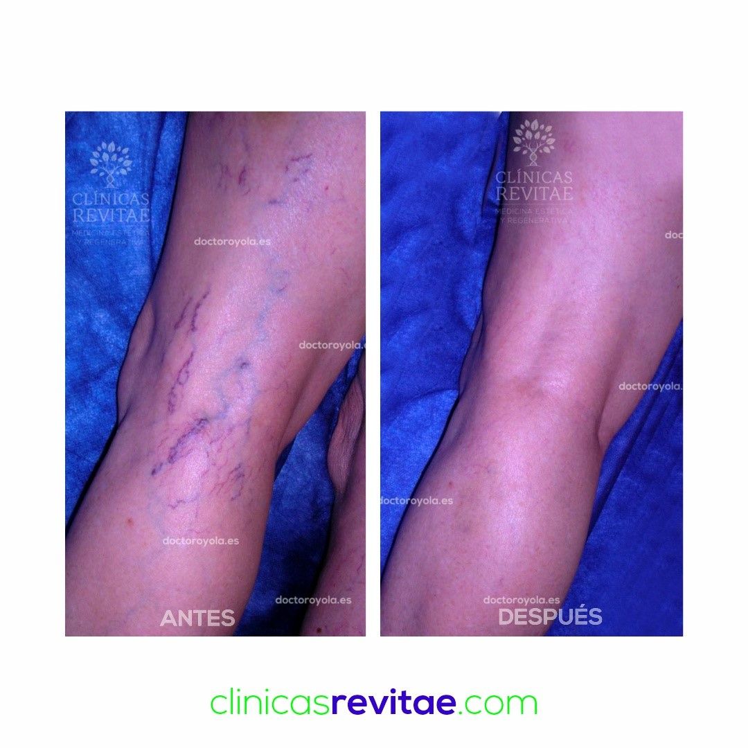 Antes y después de un tratamiento de Fleboterapia Tridimensional Regenerativa.