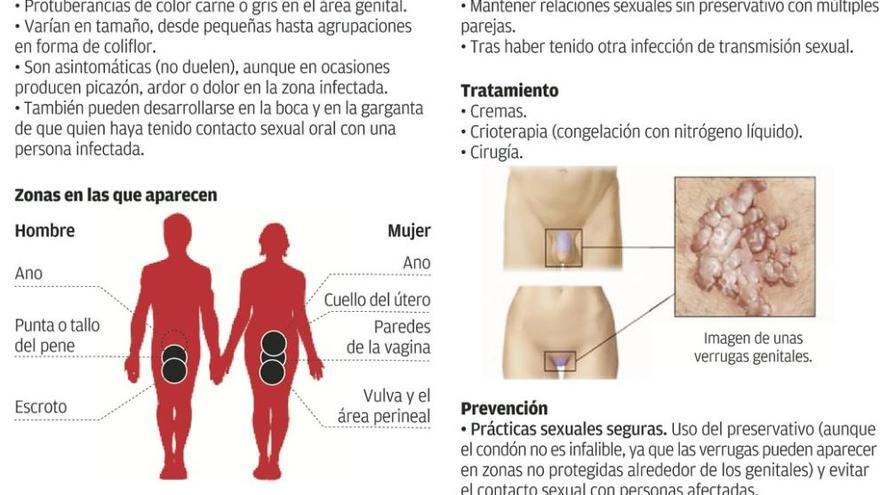 El San Agustín detecta un repunte de las infecciones de transmisión sexual