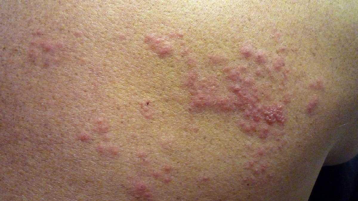 Les erupcions que provoca l'herpes zòster.