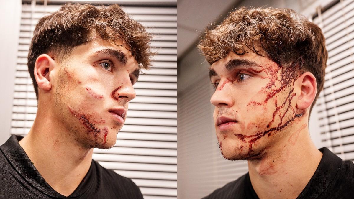 Las heridas de Pau Cubarsí tras el partido ante Estrella Roja