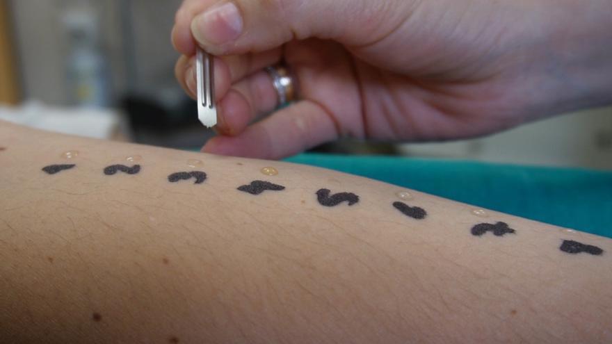 Imagen de recurso de un paciente sometido a una prueba de alergias.