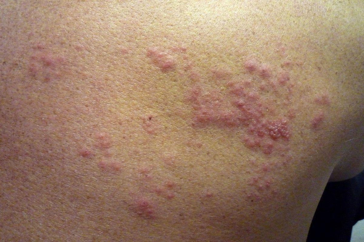 ¿Qué es el herpes zoster?