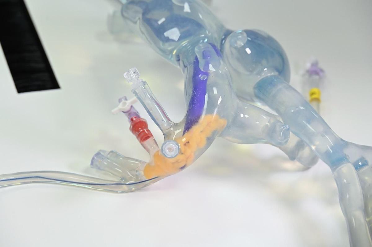 Recreación de una  trombectomía mecánica