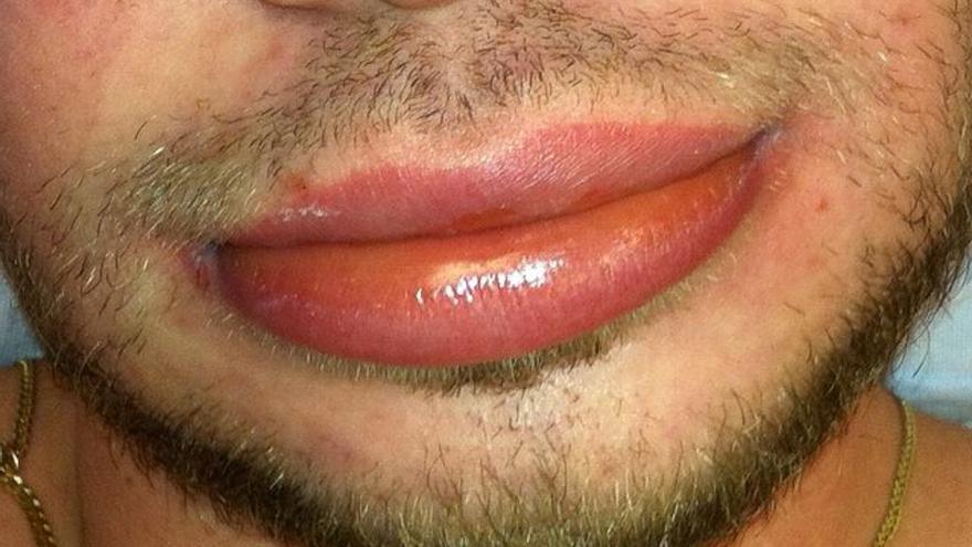Angioedema hereditario: qué es, síntomas y tratamiento de esta rara enfermedad
