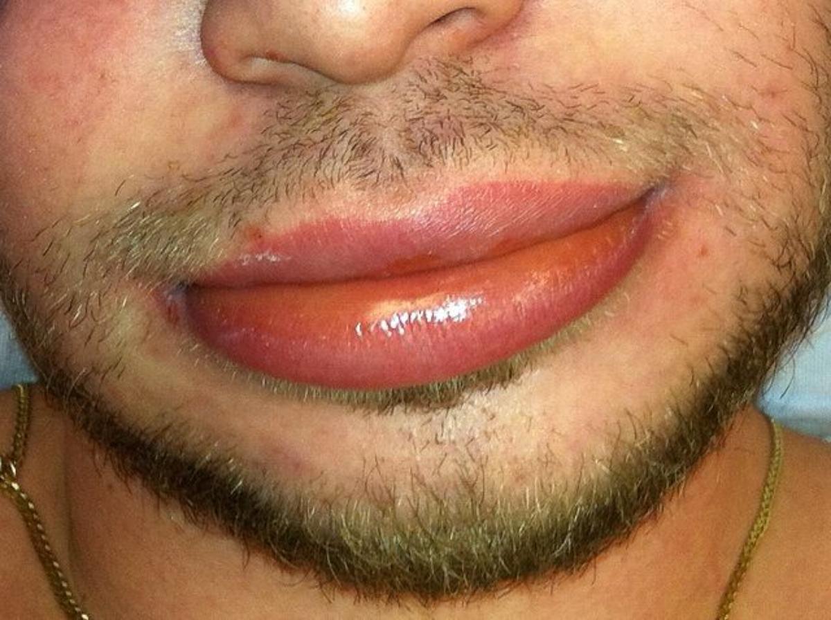 ¿Qué es el angioedema hereditario? Causas, síntomas y cómo se trata