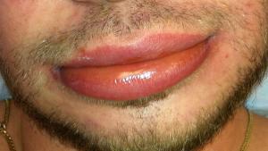 ¿Qué es el angioedema hereditario? Causas, síntomas y cómo se trata