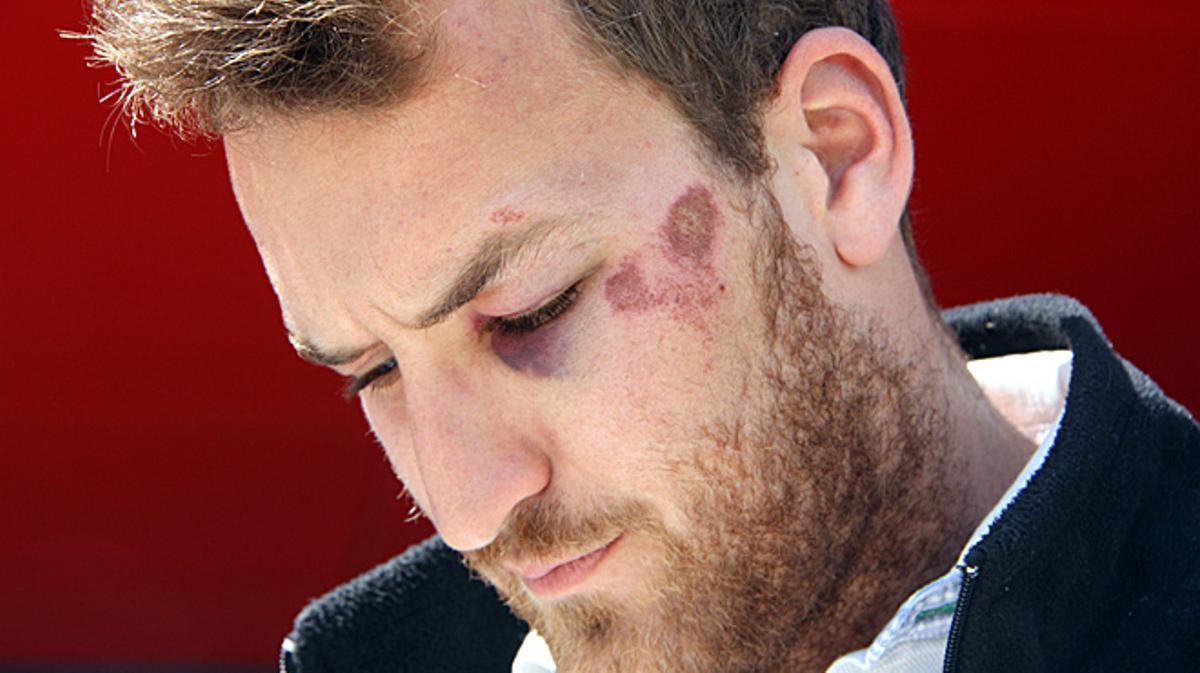 Rafel Martín, que tiene un ojo morado y golpes por todo el cuerpo, ha denunciado la agresión policial ante los Mossos d’Esquadra.