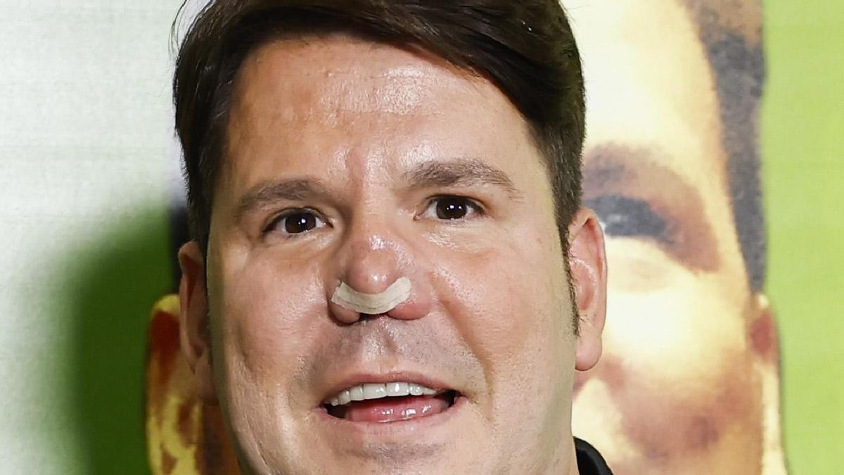 Lucas, de Andy y Lucas, se ha sometido a una reconstrucción nasal en Turquía