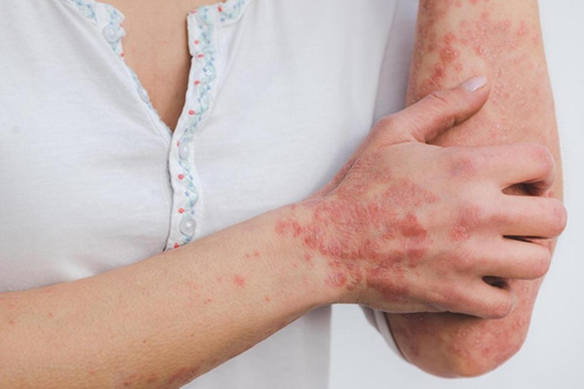 Lesiones cutáneas características de la psoriasis