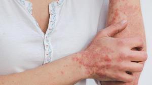 Lesiones cutáneas características de la psoriasis