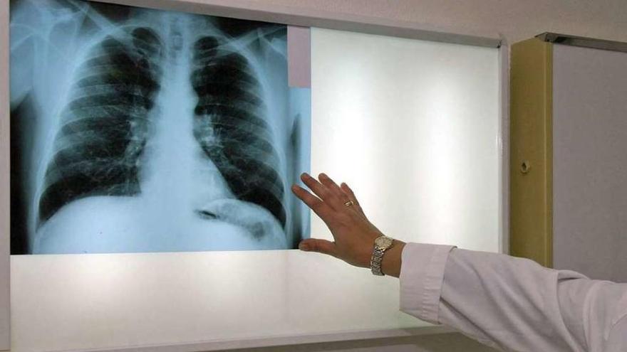 Galicia, a la cabeza en casos de tuberculosis pese a que bajaron a la mitad en diez años