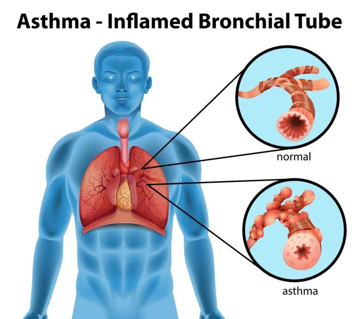 Inflamación de los bronquios por asma