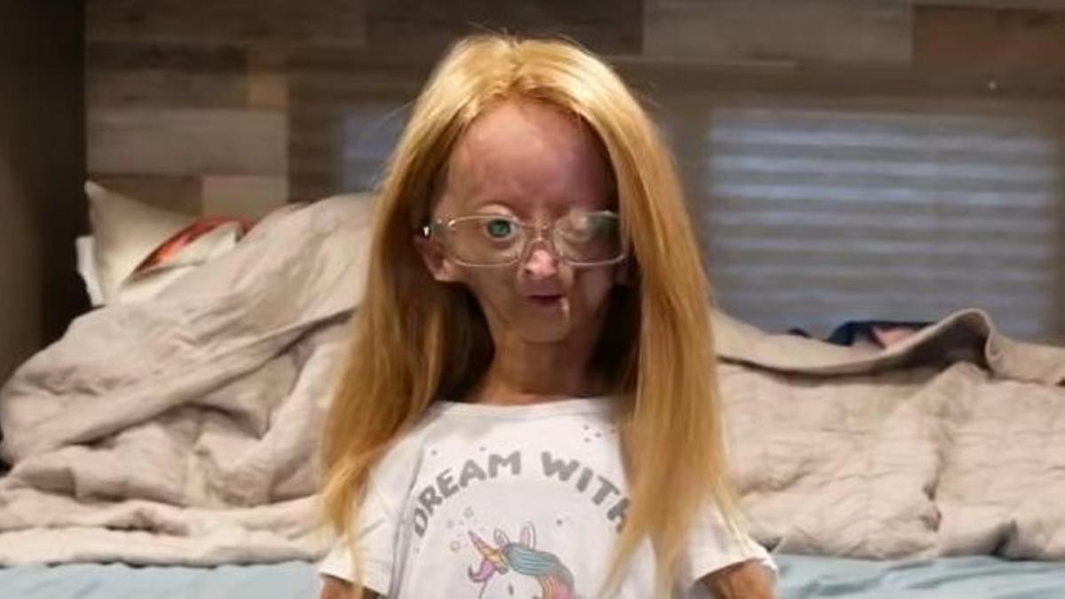 Adalia Rose Williams, 'youtuber' con síndrome de Progeria de Hutchinson-Gilford.