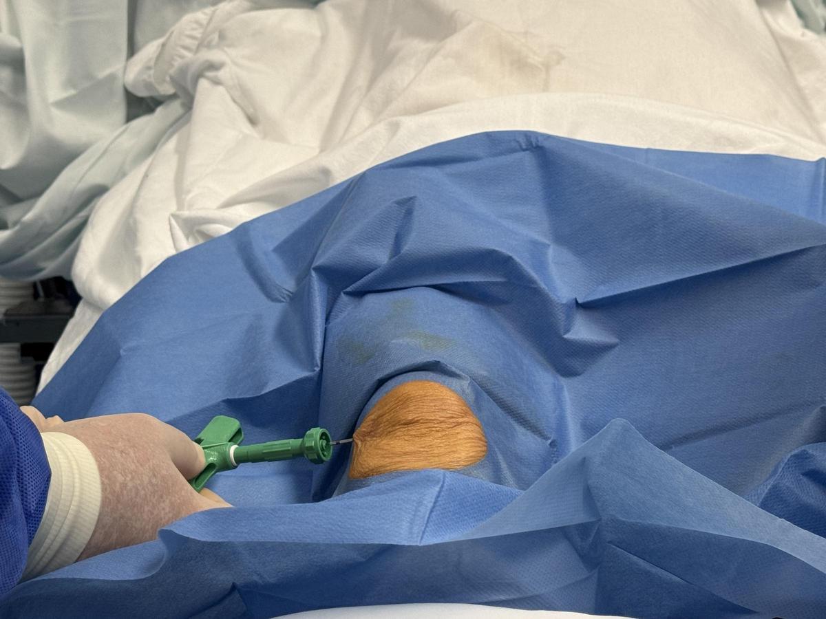 Moment der Injektion der Stammzellen in das von Chondropathie betroffene Knie.