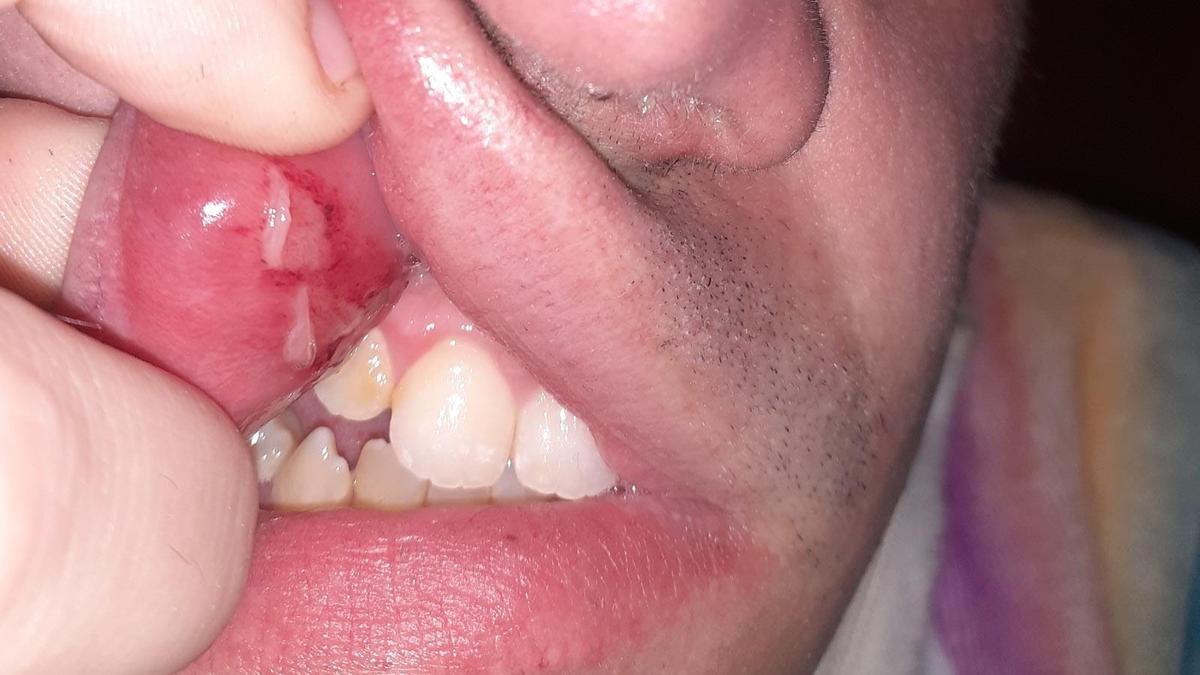 Imagen de las lesiones que presenta en la boca uno de los dos agredidos.