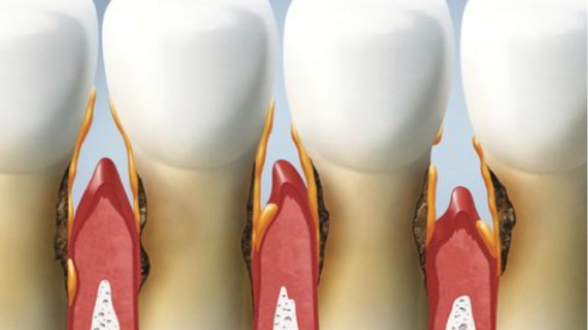 La enfermedad periodontal es crónica y tiene predisposición genética.