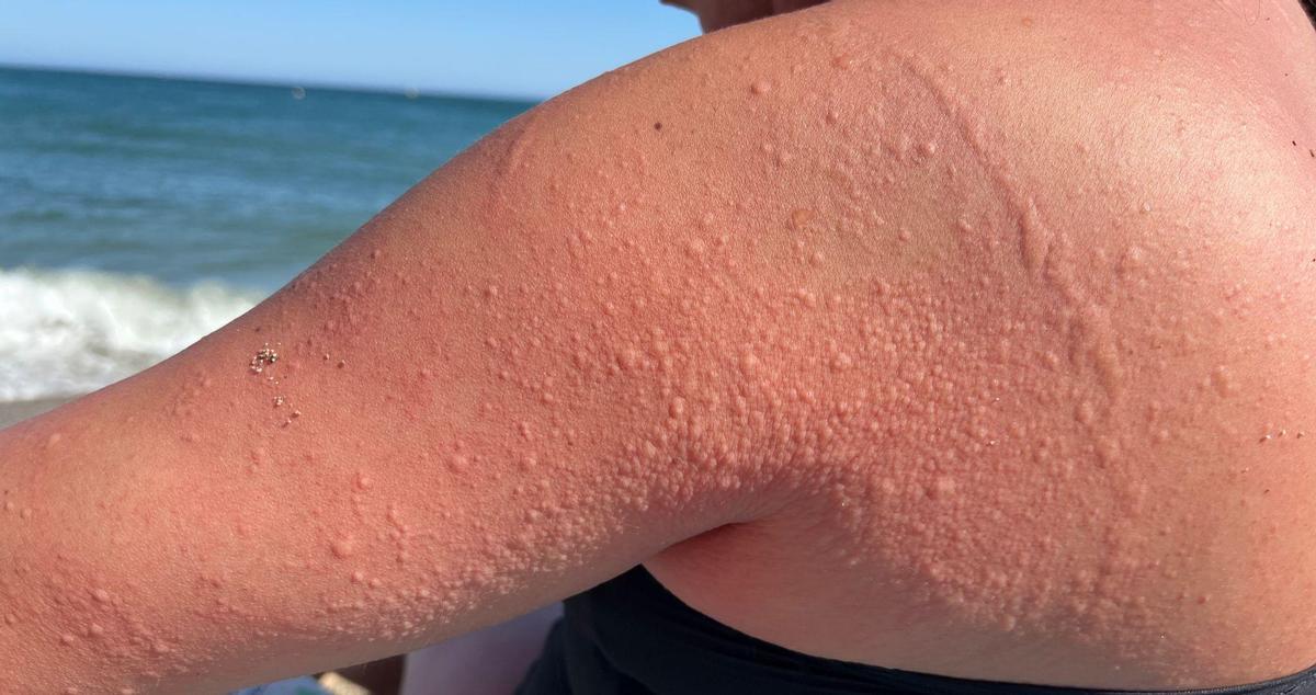 Erupción por la urticaria por frío que comenzó a tener María Trigueros este verano.