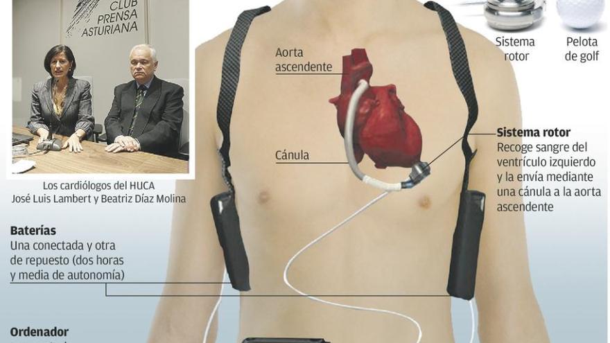 El HUCA prevé poner cada año cinco corazones artificiales de larga duración