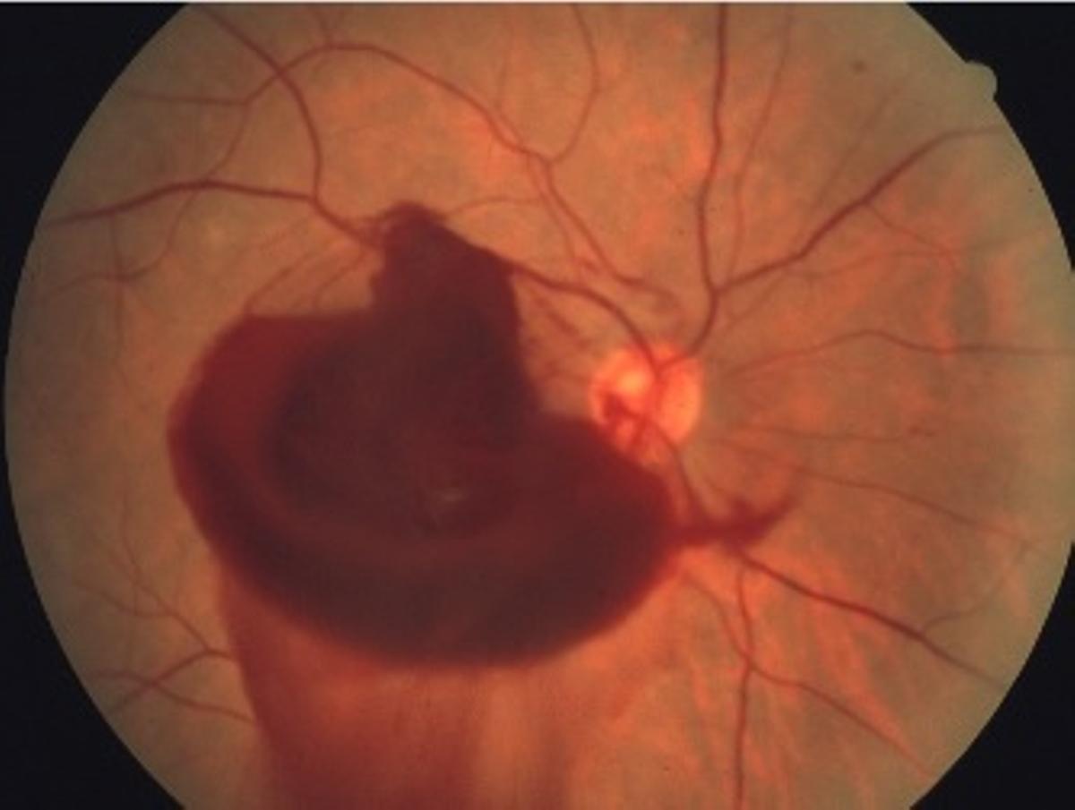 Fondo de ojo de un paciente afectado con retinosis pigmentaria, una de las patologías que deteriora el funcionamiento de la retina.