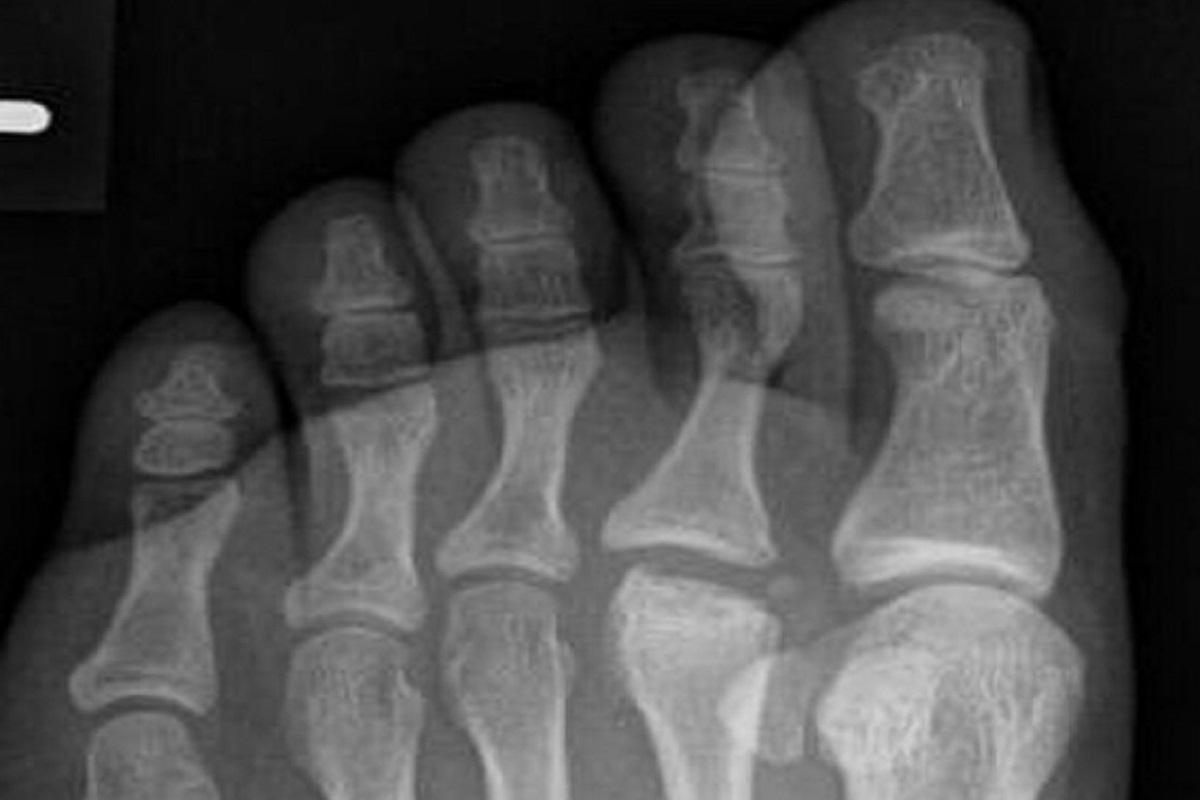 Esta alteración en los dedos de los pies es más habitual entre mujeres.
