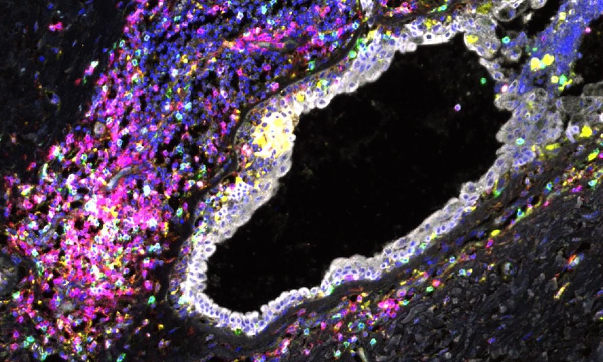 El mayor atlas de células mamarias aporta nuevos datos para prevenir el cáncer de mama