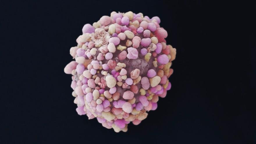 Imagen detallada de una célula con cáncer de mama