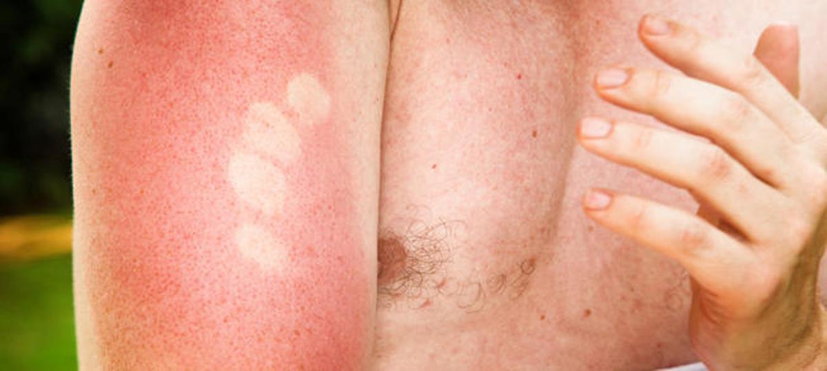 Consells per alleujar la pell després d'una cremada solar