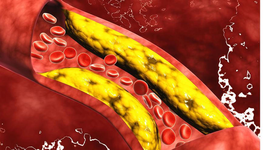 El colesterol &quot;malo&quot; puede colapsar nuestras arterias.