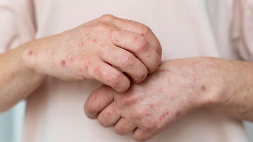 Estos son los síntomas del sarampión: hay 8 brotes en España